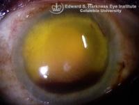 Corneal Blood Staining